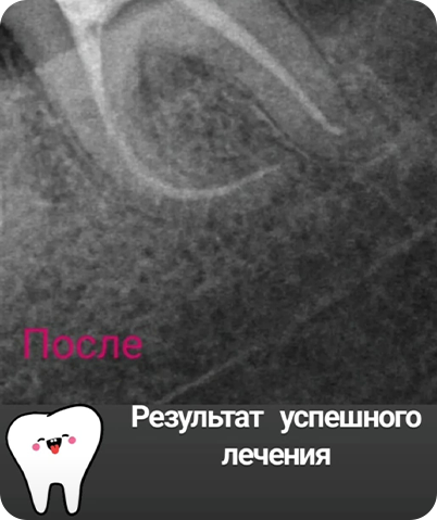 Лечение зубов - изображение 3