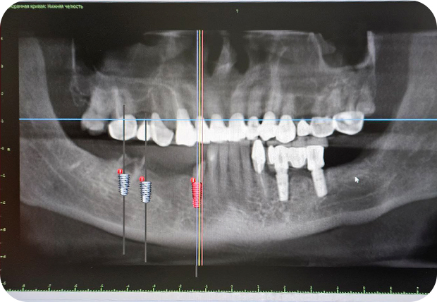 Подготовка к имплантации - фото 1